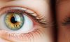 What is iris heterochromia?