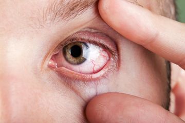   12 de Junio 2023  
 ¿Cómo afecta el síndrome de Sjögren a los ojos? 