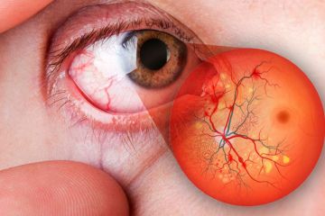   30 de Noviembre 2021  
 ¿Qué es la retinopatía diabética? 