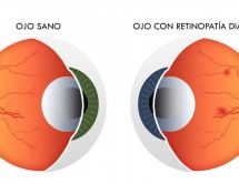 Leer noticia sobre:   21 November 2018  
 La Diabetes y sus efectos en la visión. Diario Salud 