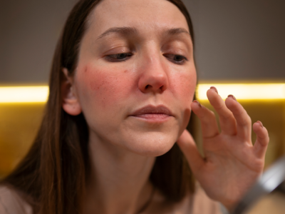 ¿Cómo afecta el lupus a la salud ocular?