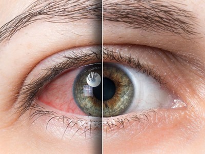 La Dra. Priscila Cedano nos habla sobre ojo seco