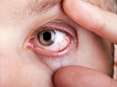 How does Sjögren's syndrome affect the eyes?