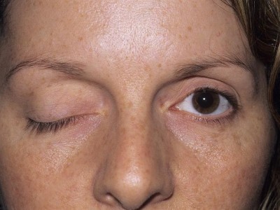 Oculomotor Nerve Palsy