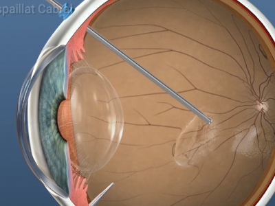 Have you heard about the vitrectomy procedure?