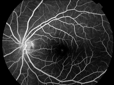 What is fluorescein angiography used for?