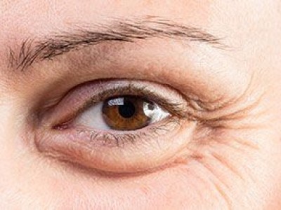 Bags Under the Eyes