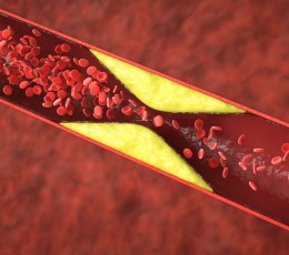 The relationship between high cholesterol and vision