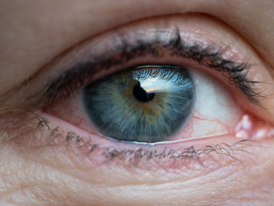 Enrojecimiento de los ojos