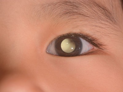 ¿Qué es la leucocoria en niños?