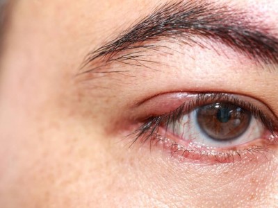 ¿Qué es un chalación y en qué se diferencia de un orzuelo?