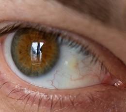 What is a pinguecula?