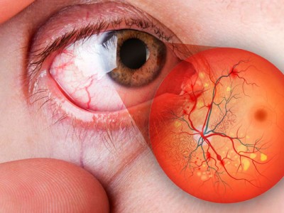 &iquest;Qu&eacute; es la retinopat&iacute;a diab&eacute;tica?